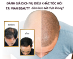 Điêu Khắc Tóc Hói Tại Vian Beauty Có An Toàn? 9