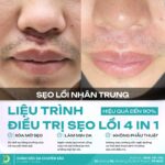 Trị Sẹo Lồi Hiệu Quả Với Liệu Trình 4IN1 Tại Dr. Choice Clinic 1 Trị Sẹo Lồi Hiệu Quả Với Liệu Trình 4IN1 Tại Dr. Choice Clinic 1
