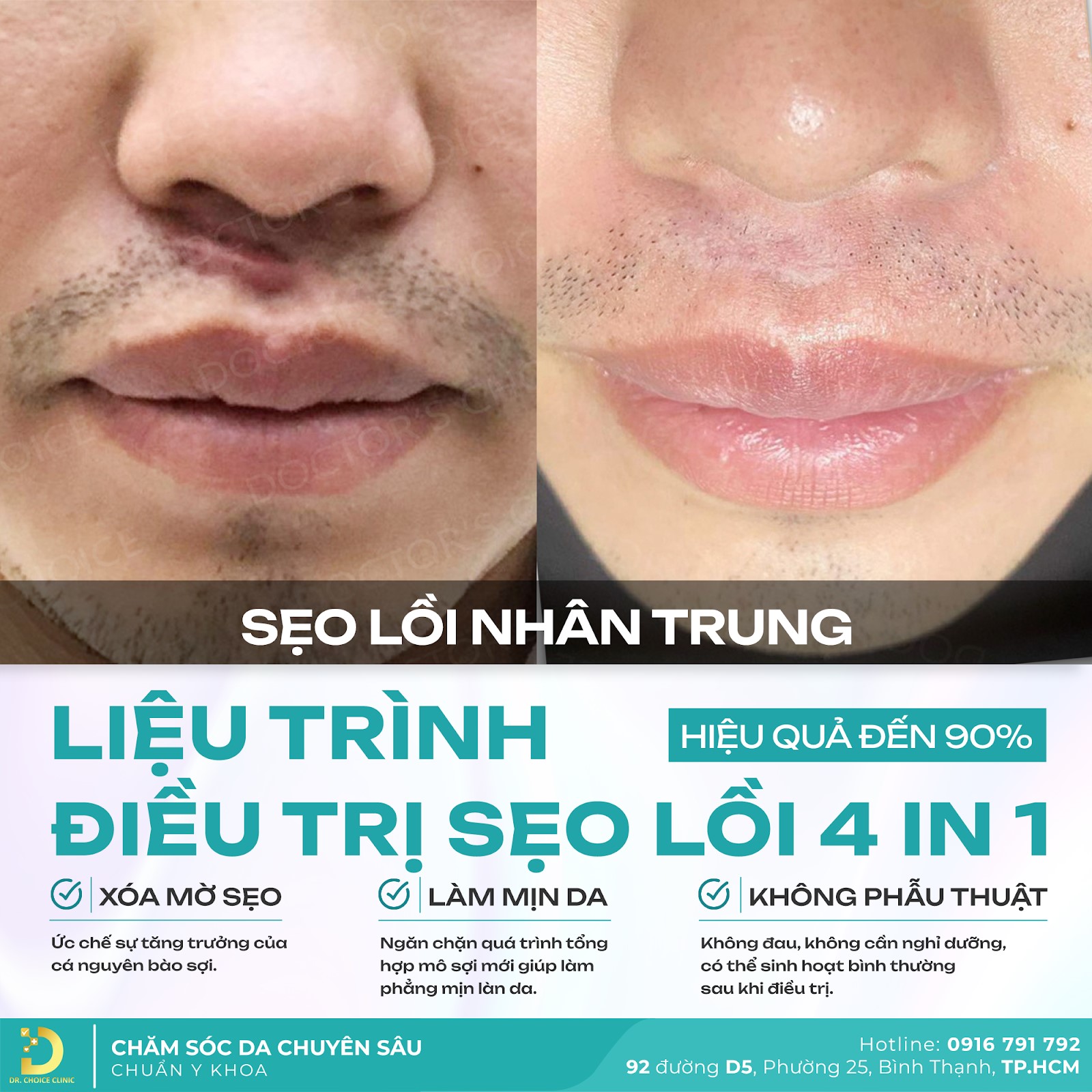 Trị Sẹo Lồi Hiệu Quả Với Liệu Trình 4IN1 Tại Dr. Choice Clinic 3