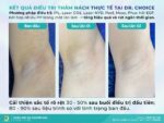 Trị Thâm Nách/Bẹn Hiệu Quả, Đẹp Tự Nhiên Cùng Dr. Choice Clinic 2