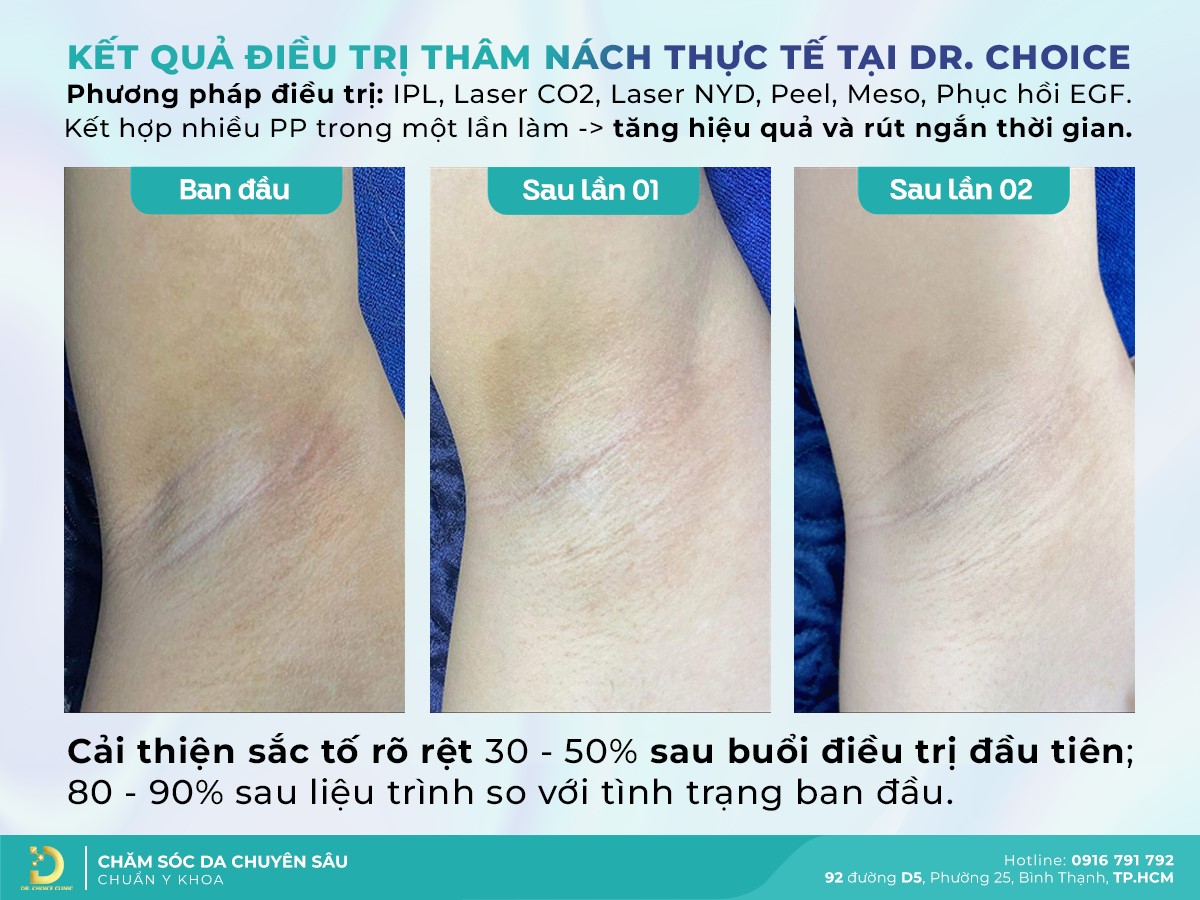 Trị Thâm Nách/Bẹn Hiệu Quả, Đẹp Tự Nhiên Cùng Dr. Choice Clinic 3